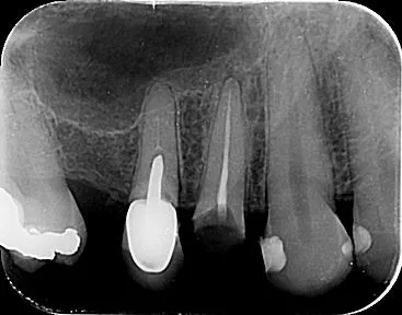 MALI SNIMAK - RETROALVEOLARNI, RETROKORONARNI - 0