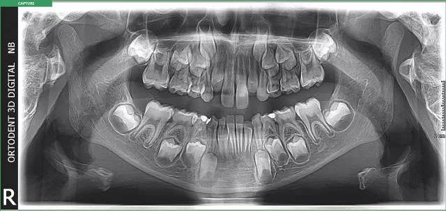 ORTOPANTOMOGRAM - 0