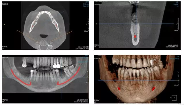 3D SNIMAK - Srednje radno polje - M (8x8) - 0