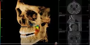 3D MAKSILARNIH SINUSA - 0