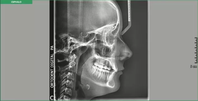 PROFILNI CEFALOGRAM - 0